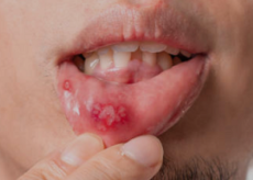 Mouth Ulcer - Home Remedy
